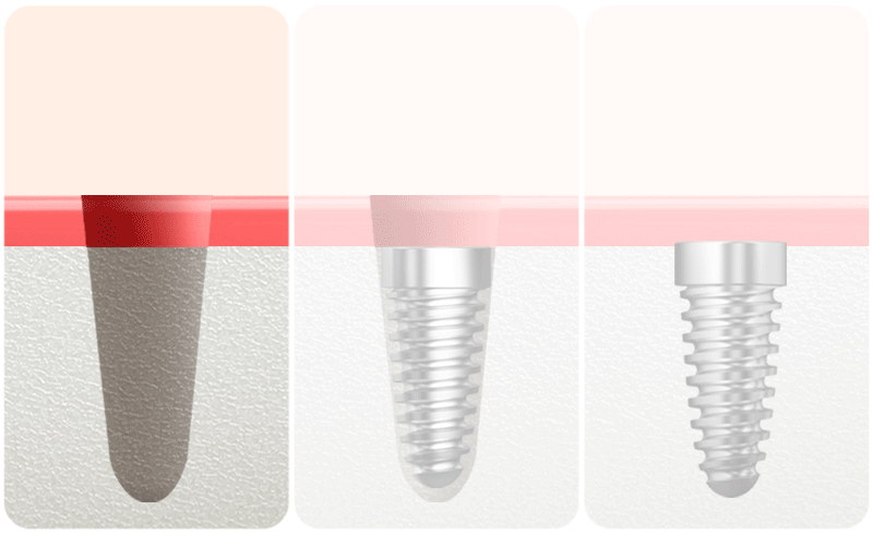 A diagram illustrating the key stages of dental implant treatment, including placement, osseointegration (healing), and prosthetic attachment.