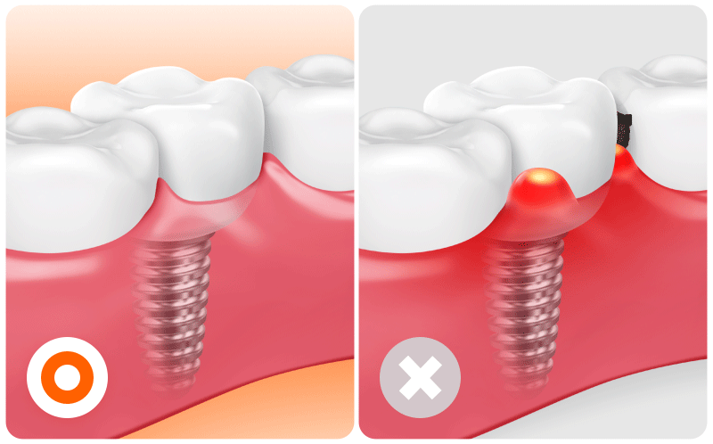 A comparative visual detailing the criteria for cases suitable for immediate dental implant placement versus cases requiring delayed placement.