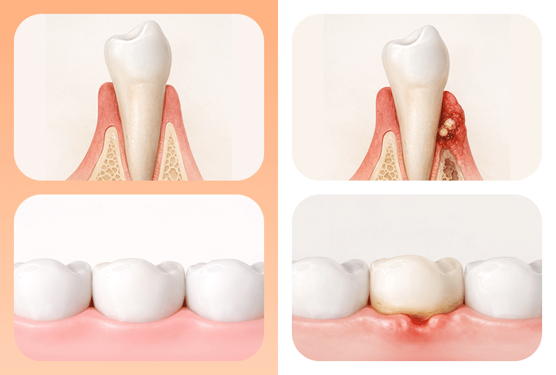 A comparative visual of alveolar bone and gum health status to consider before dental implant surgery.
