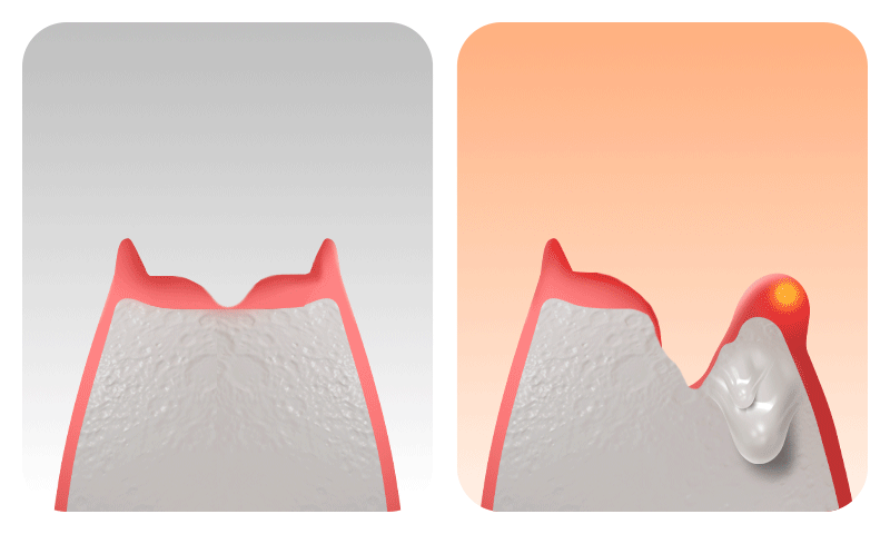 A comparative visual illustrating the difference between immediate implant placement and delayed implant placement following tooth extraction.
