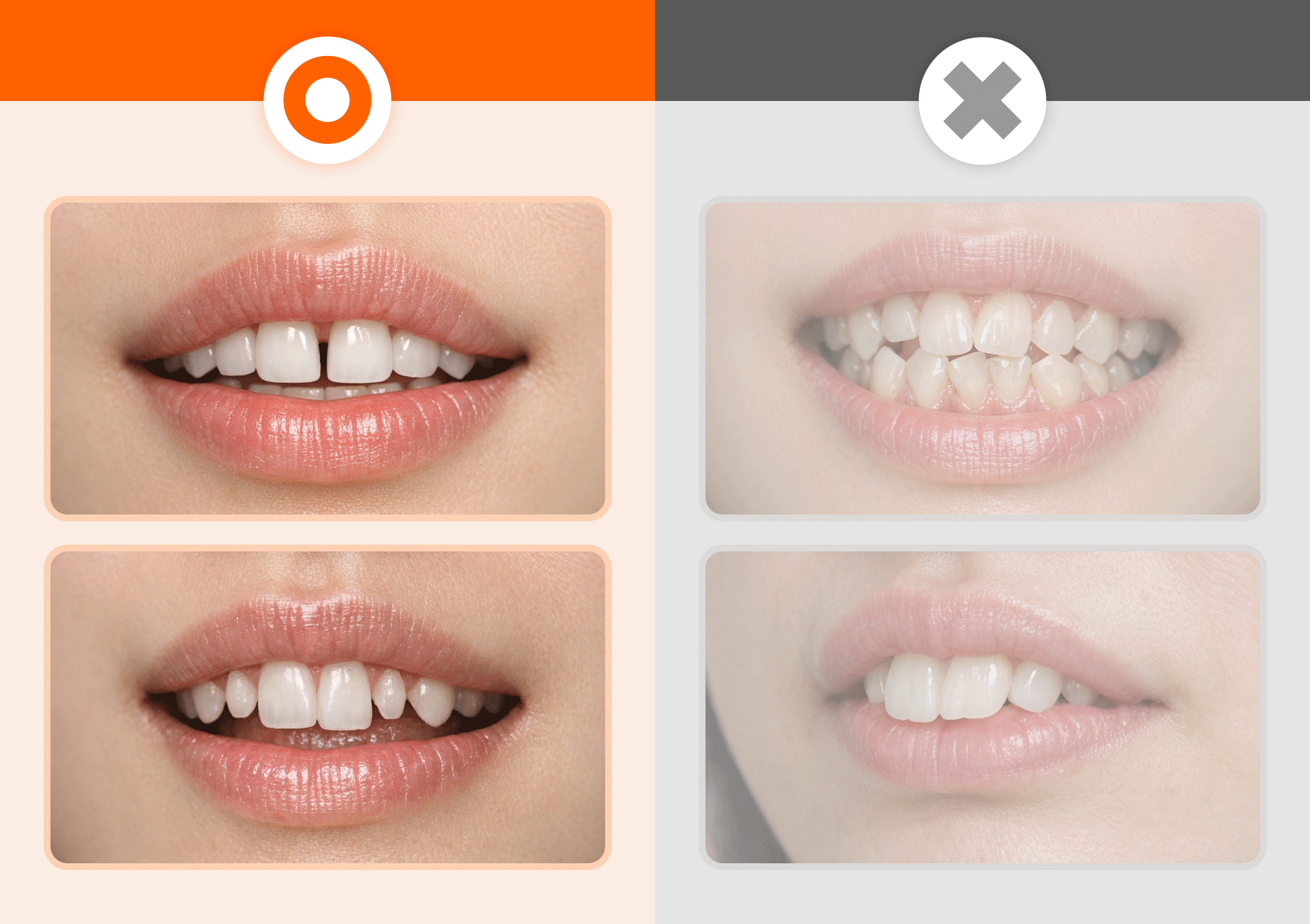 라미네이트 시술 적합 대상 치아와 주의가 필요한 치아 비교 인포그래픽.