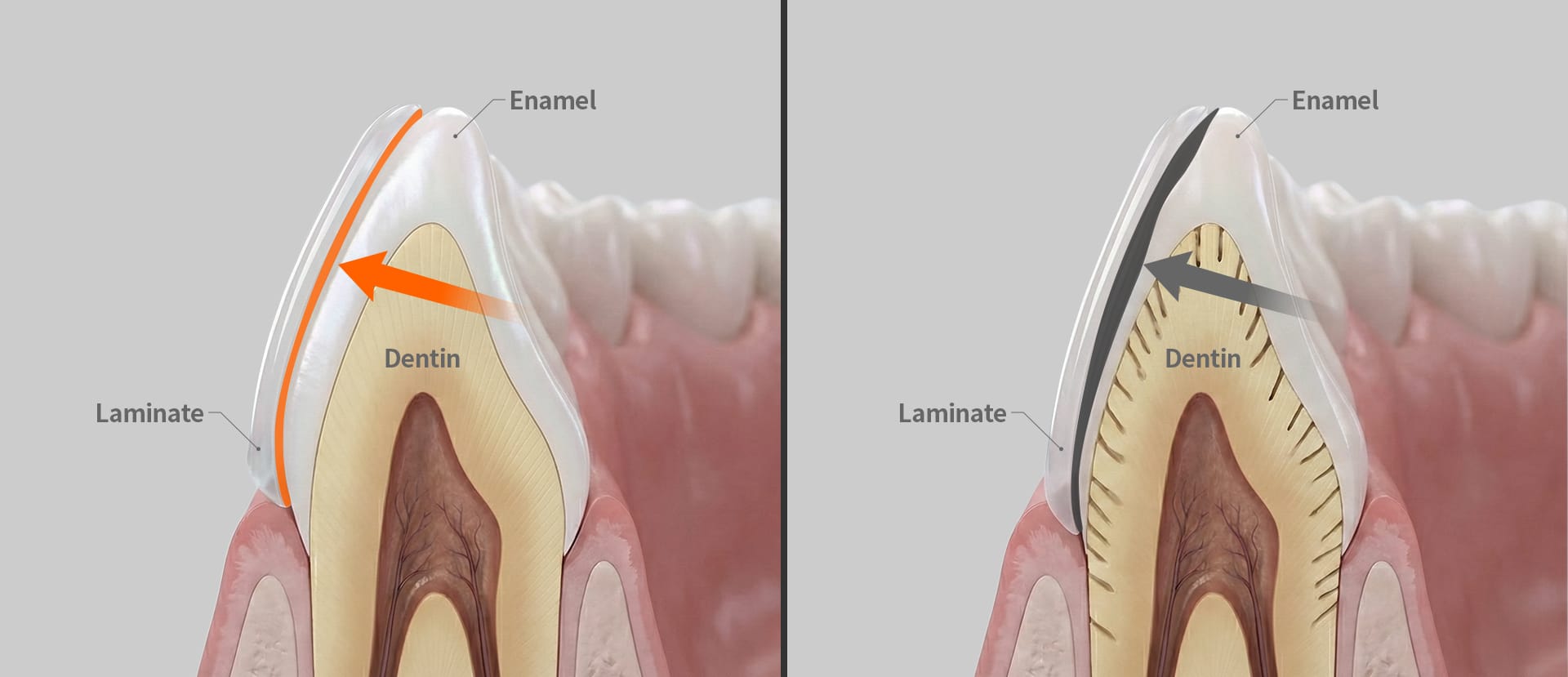 법랑질에 부착할 때 접착력이 강한 치아 단면 구조도.