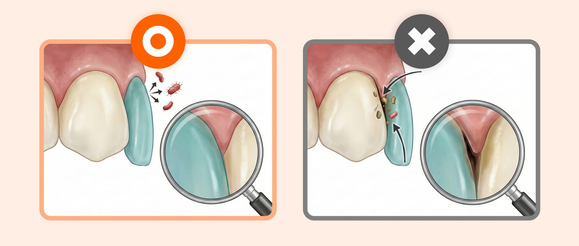 라미네이트와 잇몸 경계면의 단차 유무에 따른 충치 위험 비교 확대 이미지.