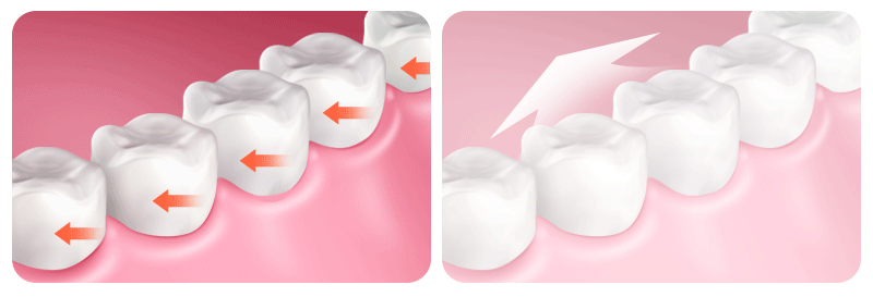 An image depicting the process and sequential stages of tooth movement during orthodontic treatment.