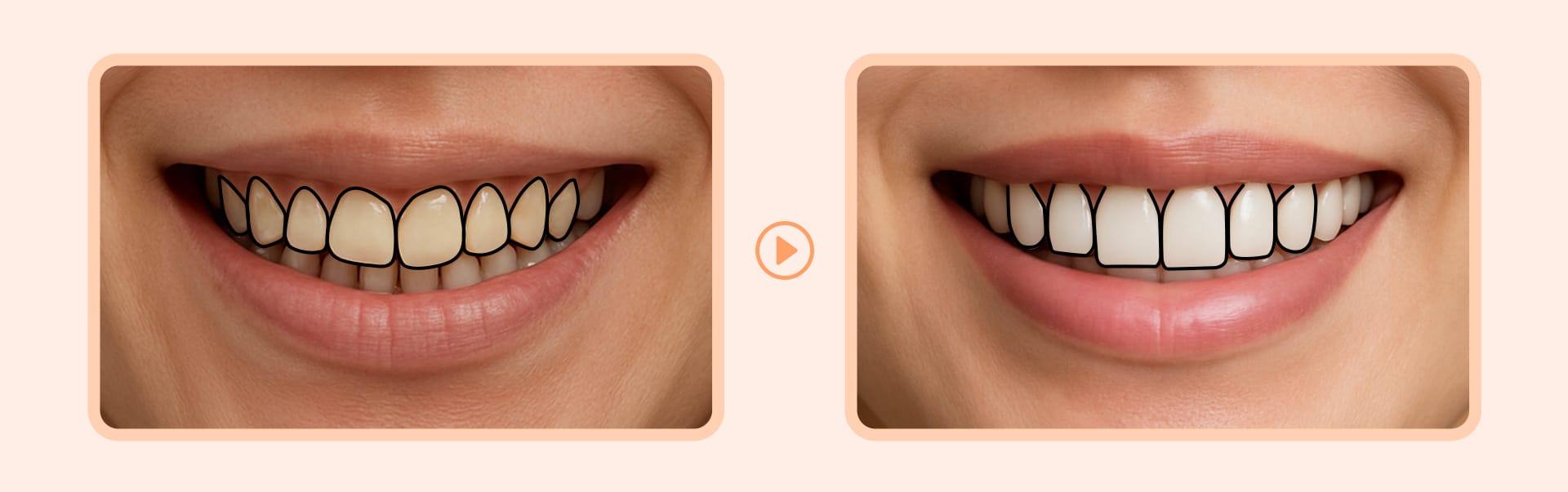 An illustration showing the gentle reshaping of the tooth line via laminates, which softens the visual protrusion of the lip line