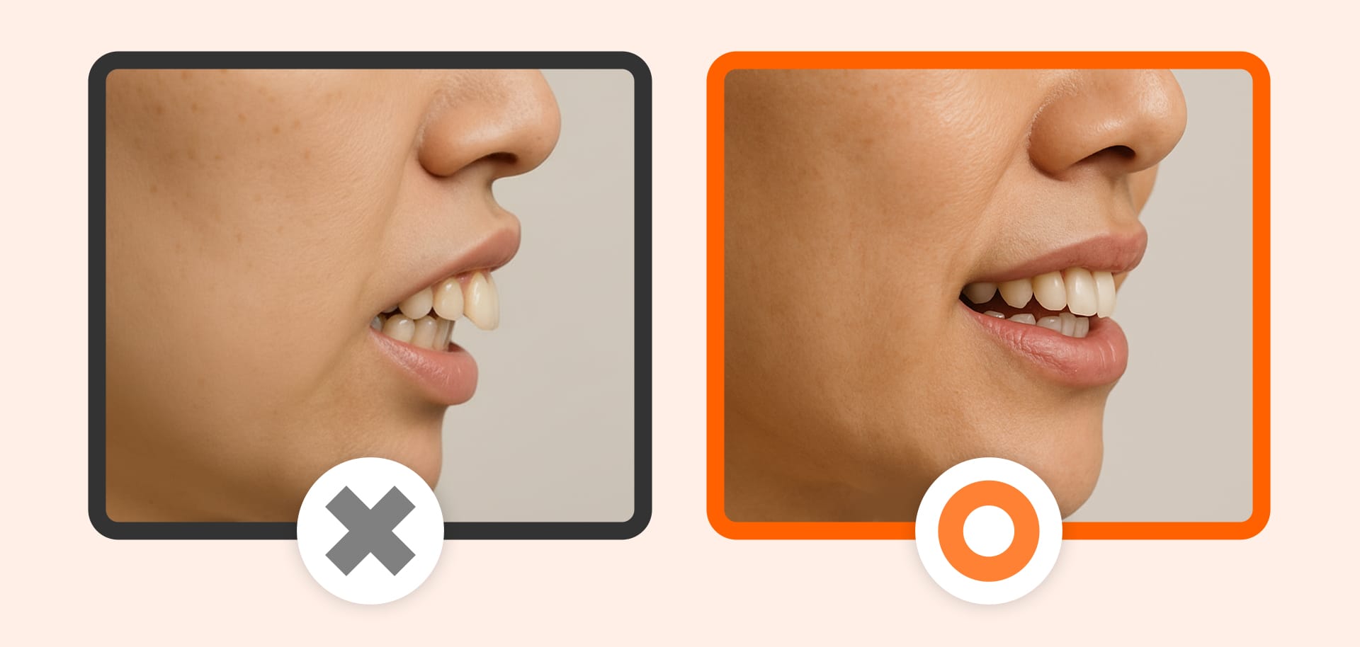 An image comparing a minor tooth tilt (Laminate possible: O) with severe tooth root protrusion requiring orthodontics (Laminate impossible: X)