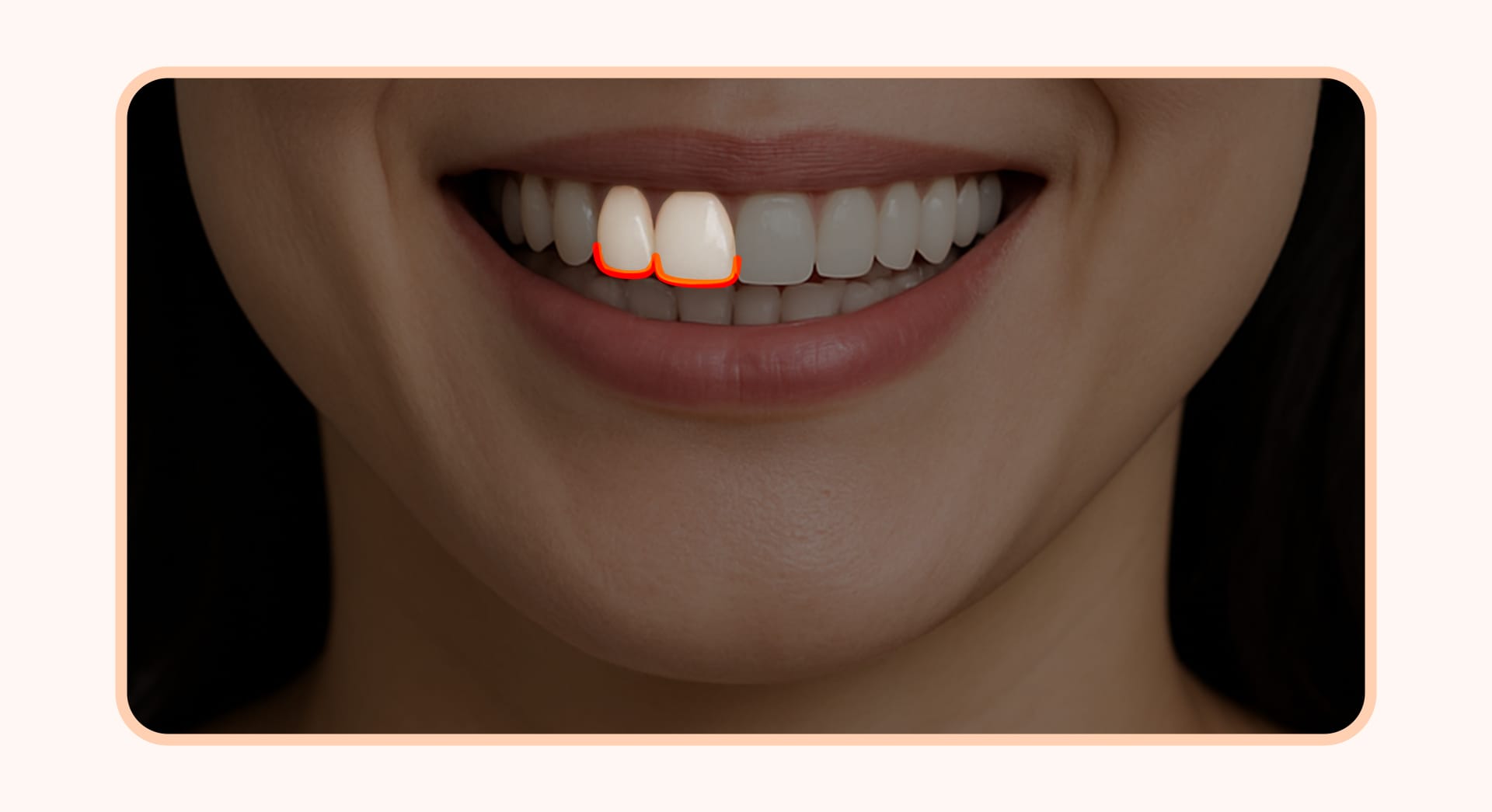 An illustration defining the ideal smile line where the curve of the upper front teeth edges aligns parallel to the curve of the lower lip