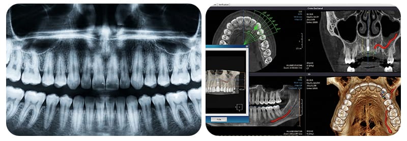 A comparative visual illustrating the difference between 2D panoramic X-rays and 3D CBCT/DICOM dental imaging data for precise implant planning.