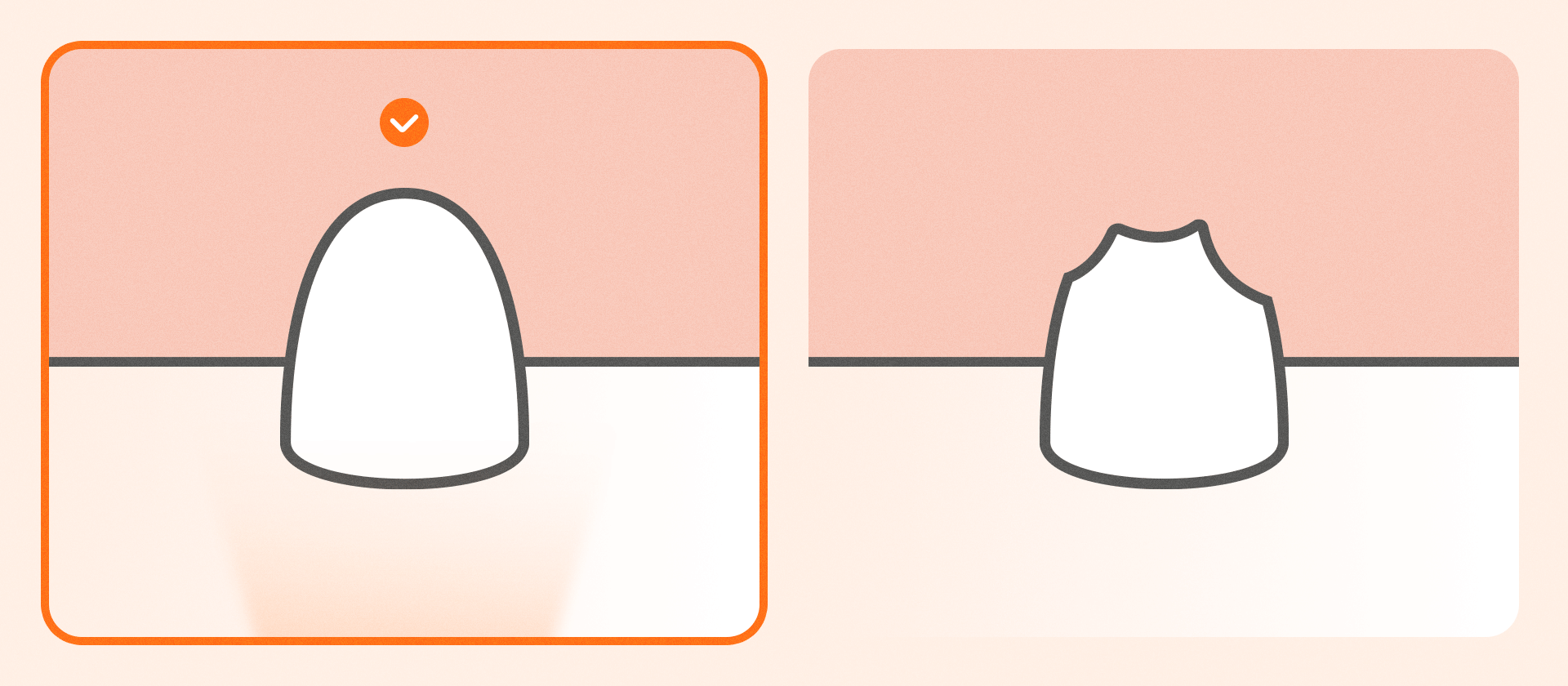 치아와 잇몸 경계선(마진)의 위치에 따른 스캔 난이도를 설명하는 인포그래픽