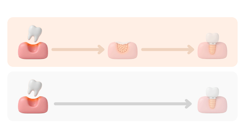 A comparative visual showing the difference in treatment duration between dental implant cases that require bone grafting and those that do not.