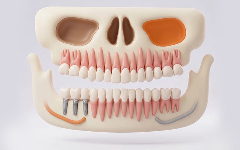 Error-free Dental Implant Placement: Digital Guided Implants in Korea