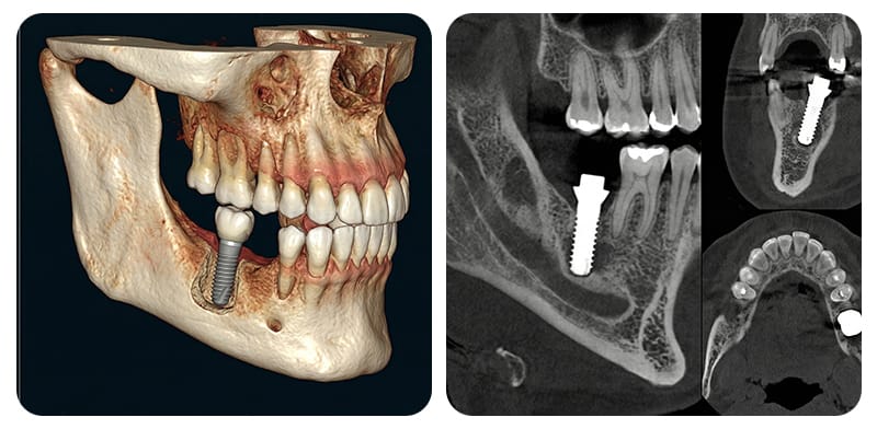 CBCT imaging for mandibular implant planning and nerve path visualization.