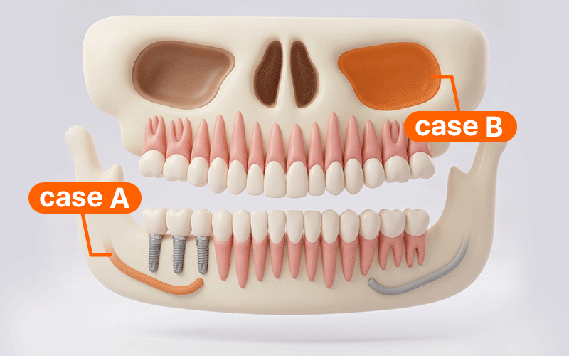 Anatomy of the maxillary sinus and inferior alveolar nerve for treatment scheduling.