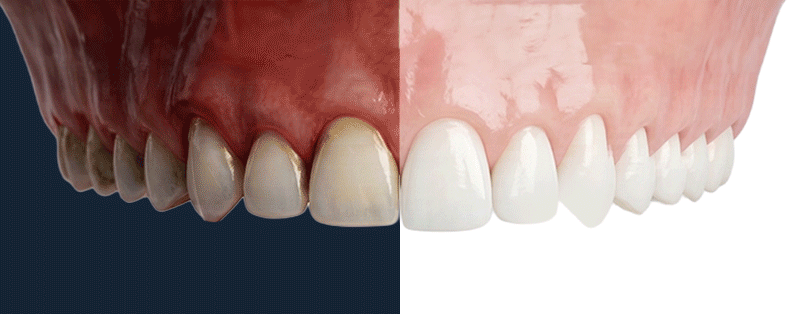 Comparison of healthy vs. unhealthy gums for 3-day implant suitability.