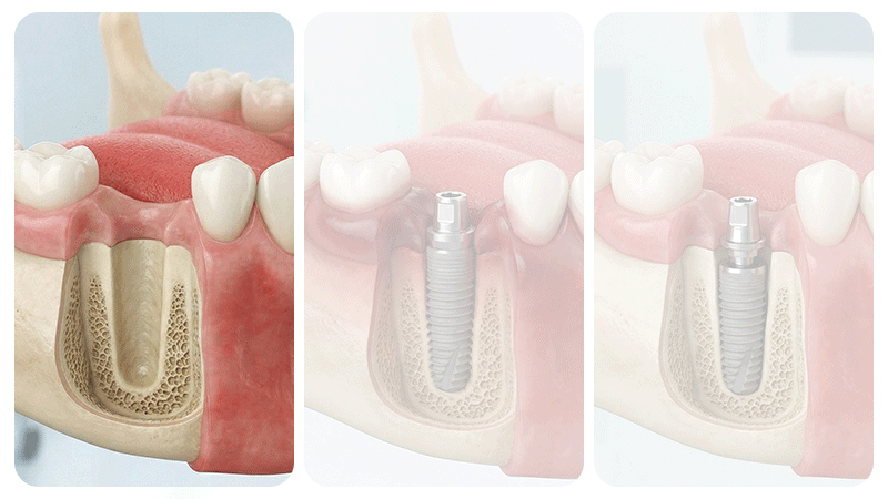 Diagram of dental implant stages: placement, healing, and final prosthetic.