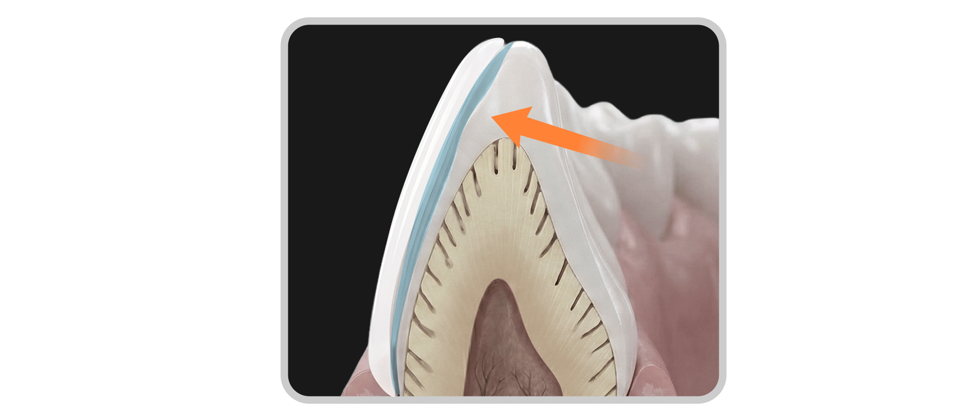 An image depicting a dental veneer detaching from a tooth in one piece.