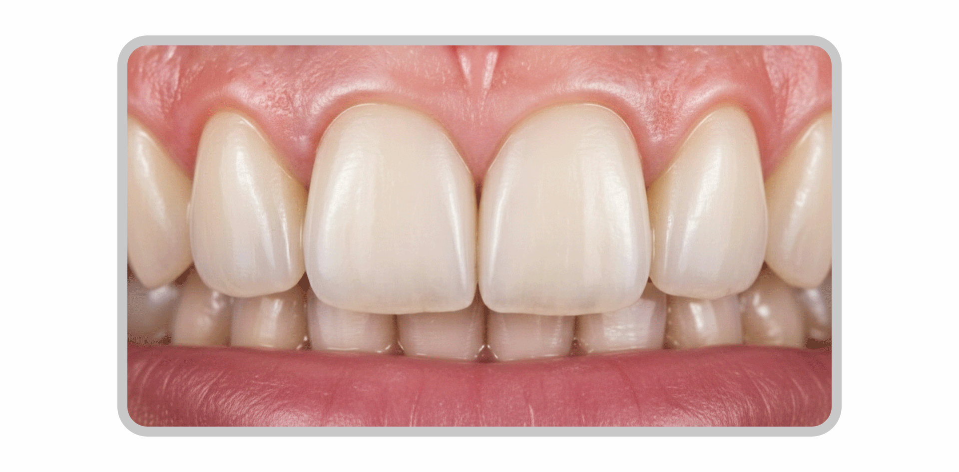 라미네이트와 잇몸 경계를 따라 점진적으로 어두워지는 변연 변색을 보여주는 확대 이미지.