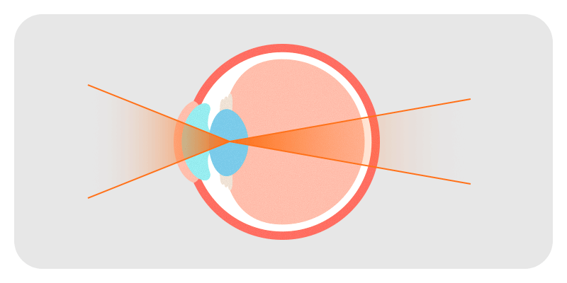An illustration showing a temporary myopic shift from cataracts, changing farsightedness to nearsightedness