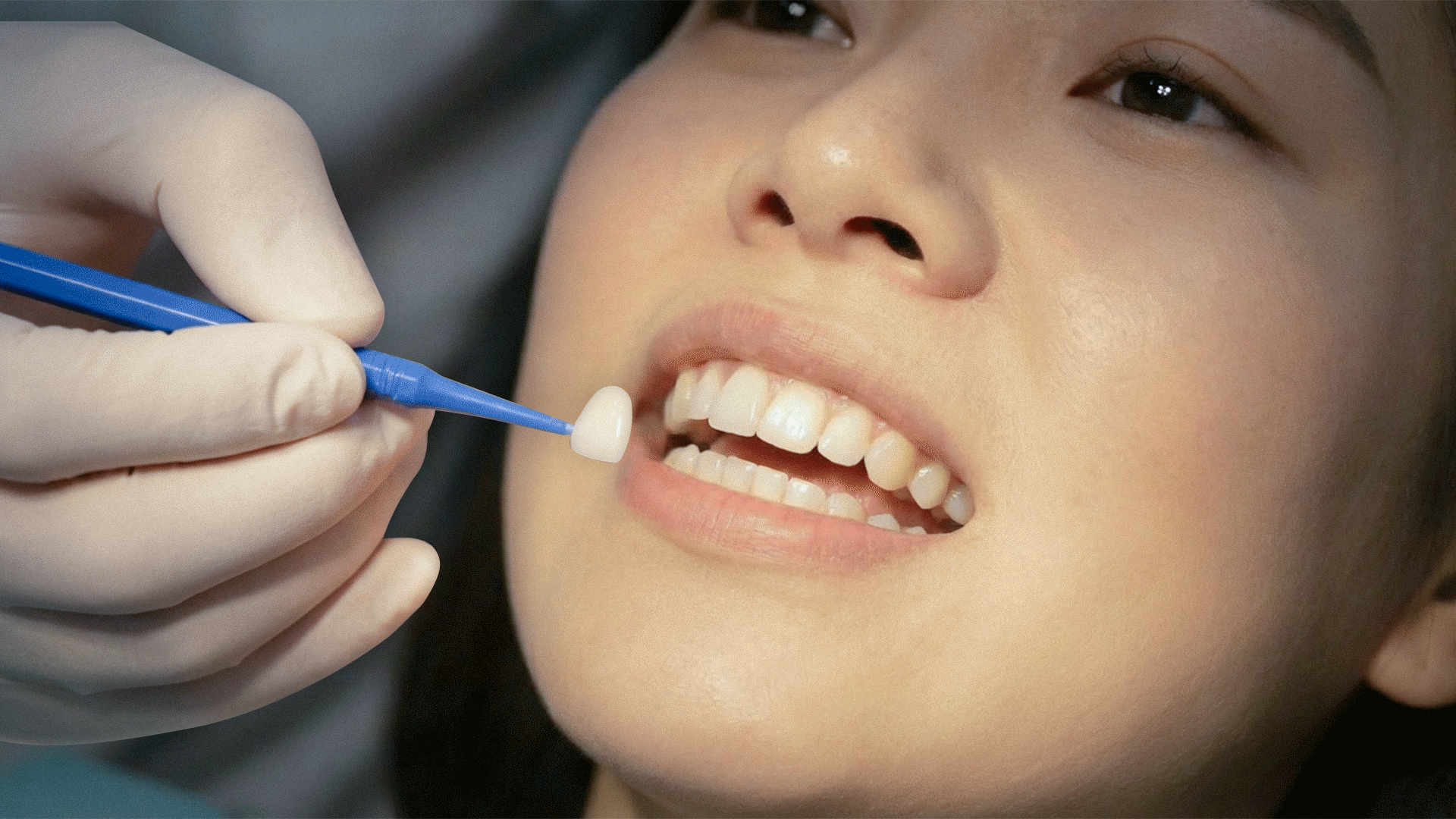 Close-up of a cosmetic dentistry try-in process to verify veneer fit and color before cementation.
