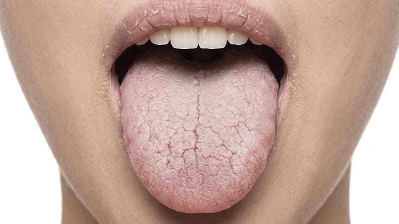 毎日繰り返される朝の口の渇き、単なる乾燥でしょうか？ 4つの点検基準