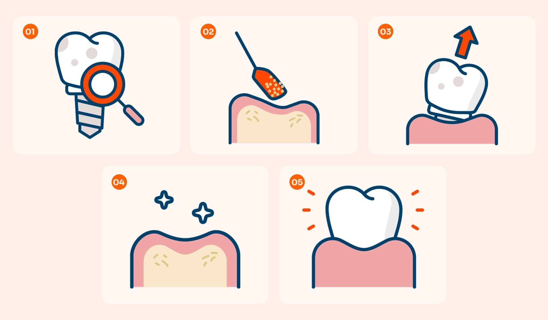 임플란트 재수술의 5단계 과정: 정밀 진단, 기존 임플란트 제거, 뼈이식, 회복 기간, 새로운 임플란트 식립 및 보철물 장착