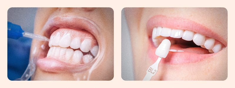 치아에 미백제를 도포하는 치아 미백 시술과 세라믹 판을 붙이는 라미네이트 시술 방법을 나란히 비교한 이미지