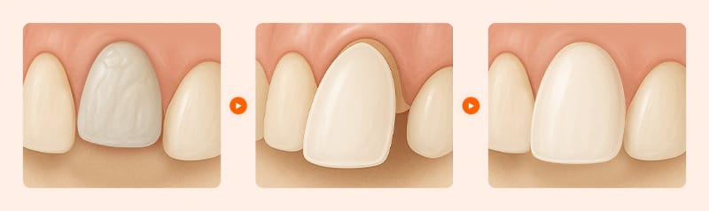 변색된 치아를 얇게 다듬고 라미네이트를 붙이는 시술 과정을 순차적으로 보여주는 의학적 이미지