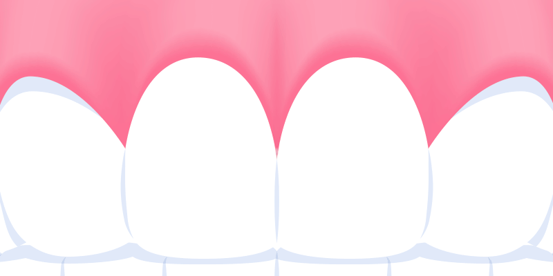 An image illustrating aesthetic issues with dental veneers, such as staining, discoloration, or chipping
