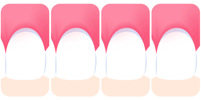 An infographic highlighting 5 warning signs that indicate a dental veneer needs to be replaced