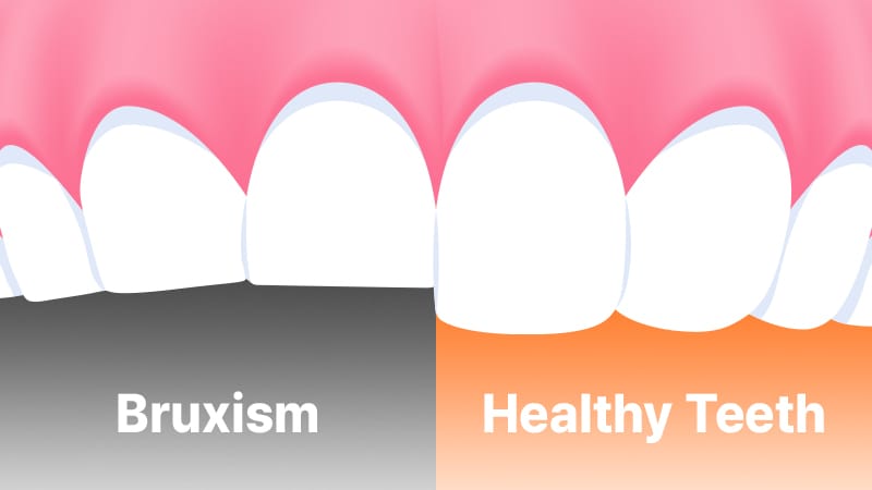 A comparison illustration showing normal teeth versus teeth showing wear and tear from bruxism (teeth grinding)