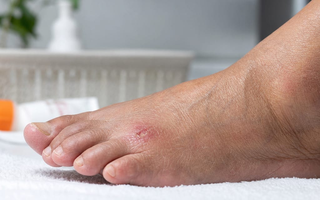 The foot of a diabetic patient showing a small wound