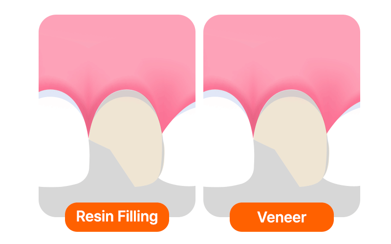 An image comparing the differences between dental resin bonding and porcelain veneers