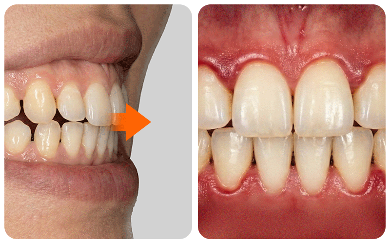 An illustration visualizing the condition of teeth drifting apart (diastema)