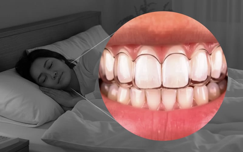 A person sleeping while wearing a custom dental night guard