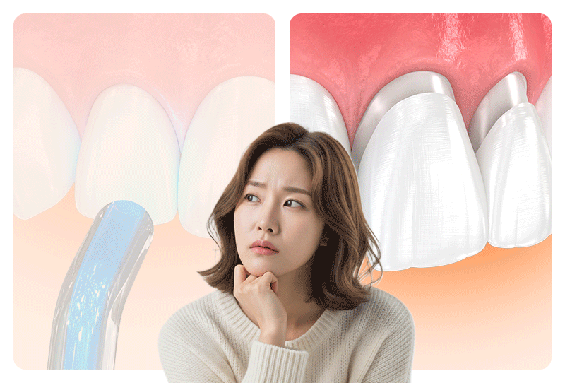 A patient contemplating between composite resin bonding and veneer treatments
