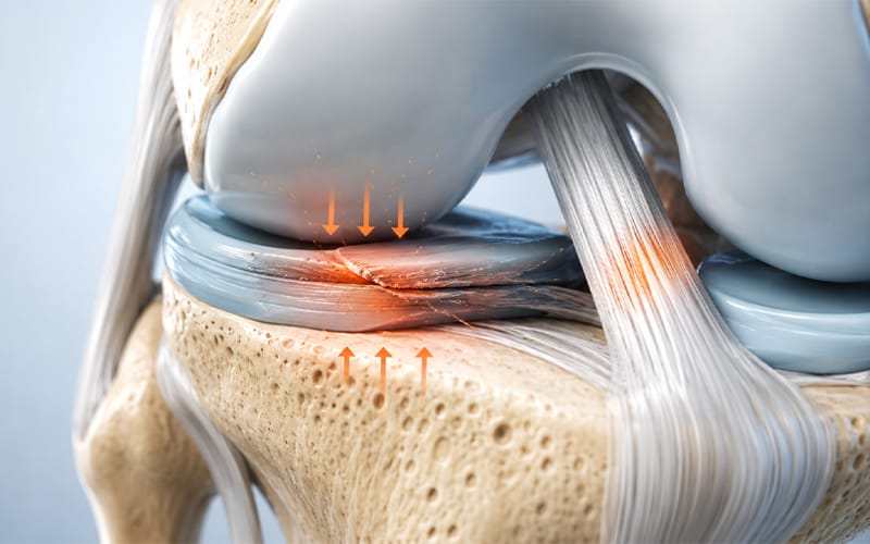 A medical illustration showing meniscus compression caused by joint instability
