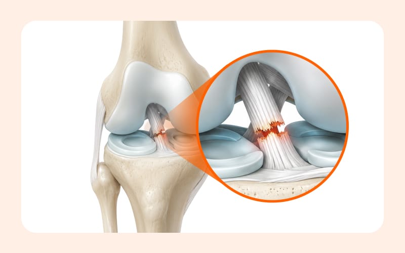 A medical illustration showing a torn anterior cruciate ligament (ACL)