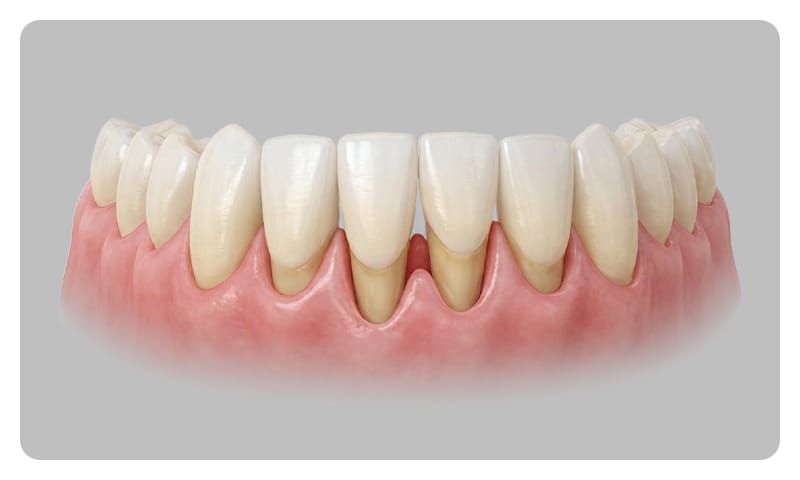 A tooth with gingival recession exposing the sensitive root surface