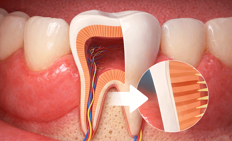 An illustration showing exposed dentin transmitting external stimuli directly to the tooth nerve