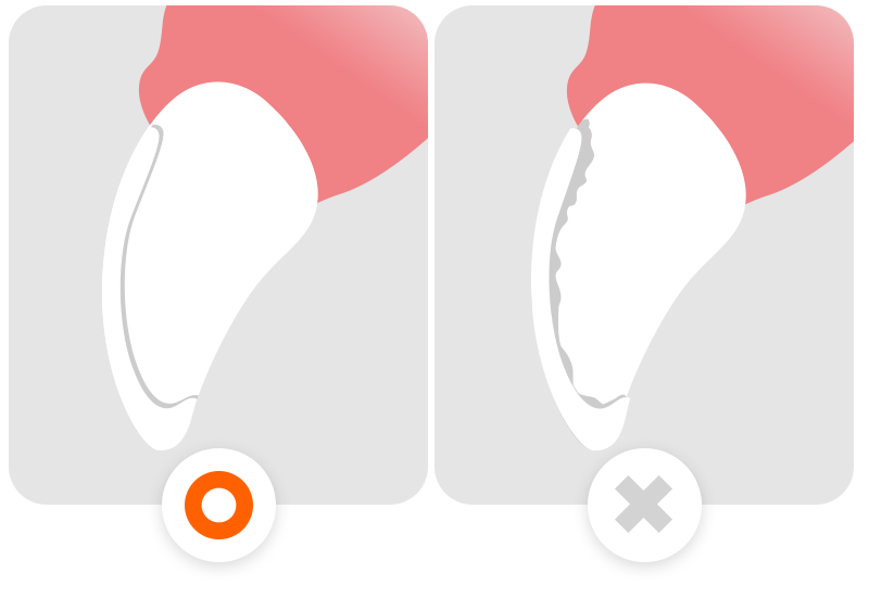 A visual diagram showing how remaining enamel thickness affects veneer bonding strength