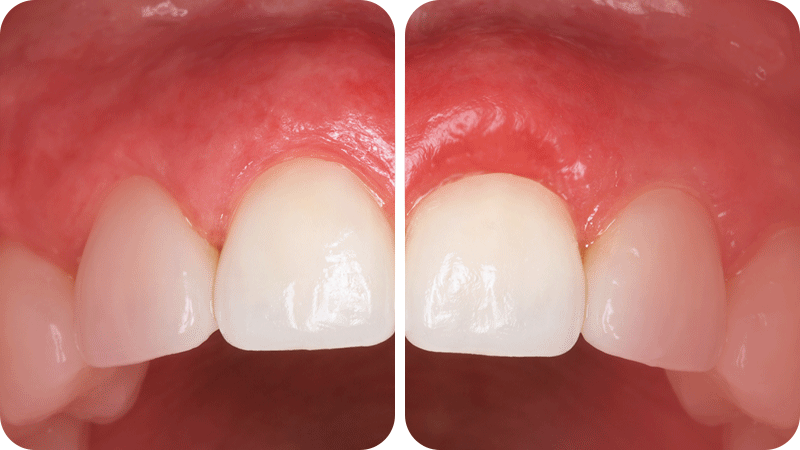 An image demonstrating the smooth margin transition between the veneer and the gumline