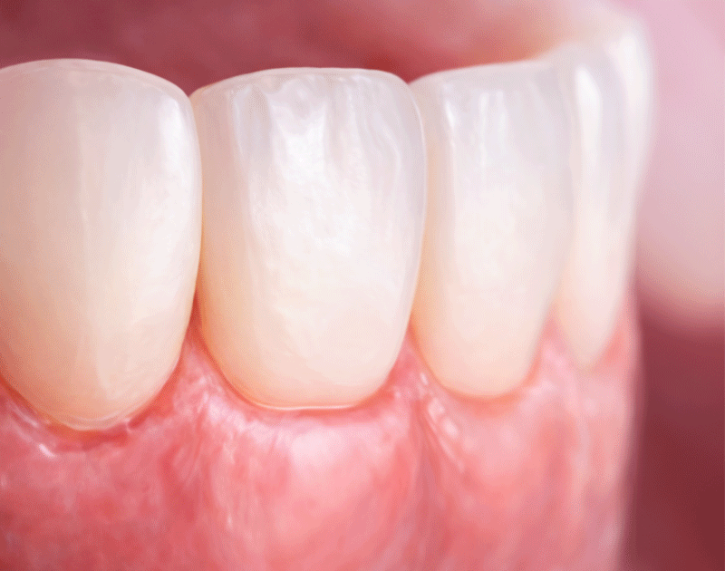 An image depicting an overly bulky or protruding tooth appearance after veneer placement