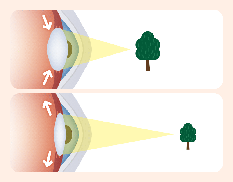 A diagram showing crystalline lens accommodation changes between distant and near vision
