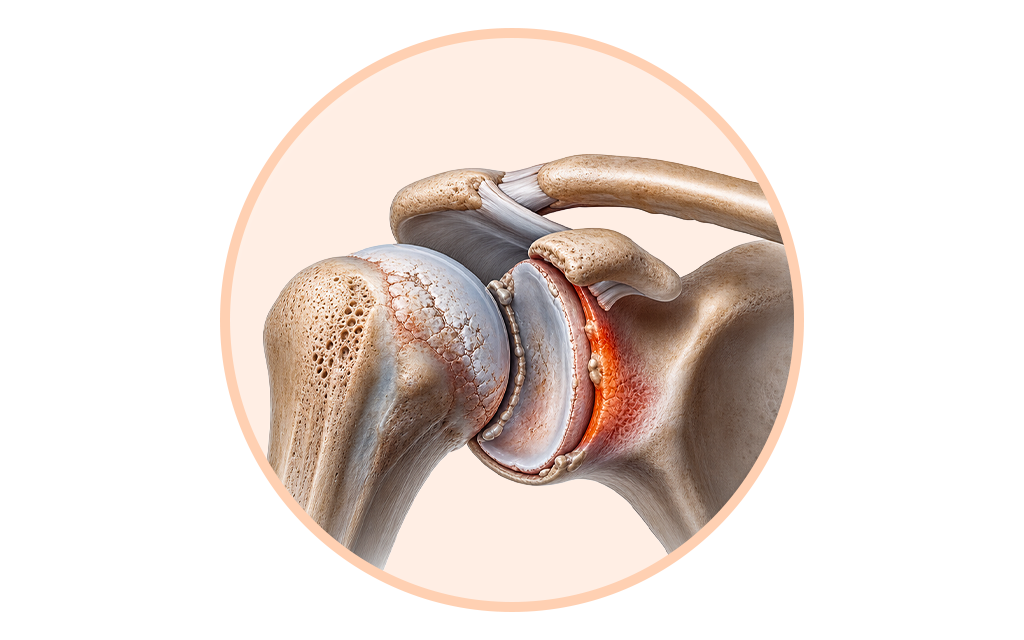 A medical illustration depicting localized inflammation within the shoulder joint