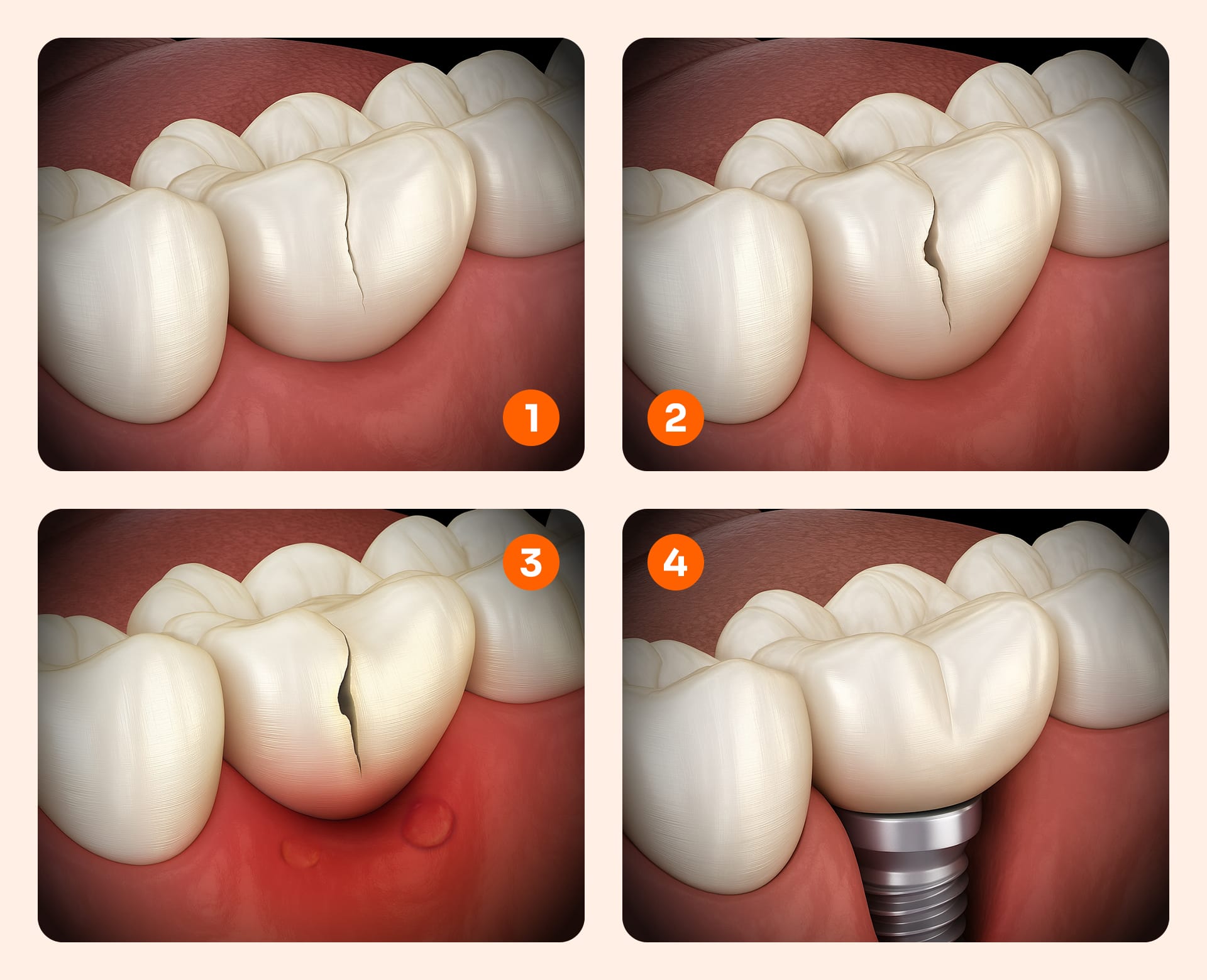 An infographic illustrating the 4-stage progression from microcracks to root fractures and dental implant replacement