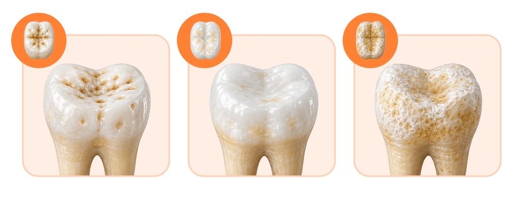 A visual breakdown showing the 3 clinical types of amelogenesis imperfecta: hypoplastic, hypomaturation, and hypocalcified