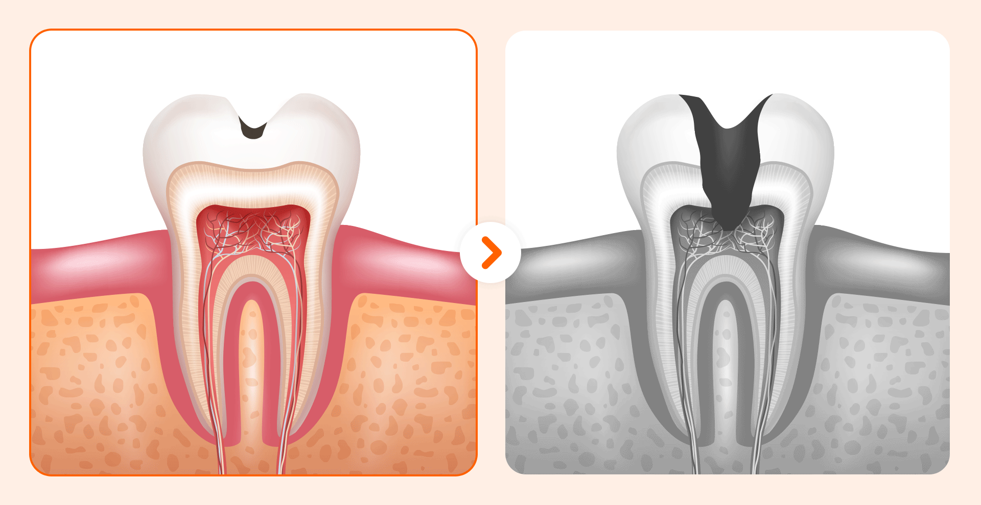An image illustrating a healthy molar cross-section gradually showing damage, with the decay expanding and penetrating deep into the dentin