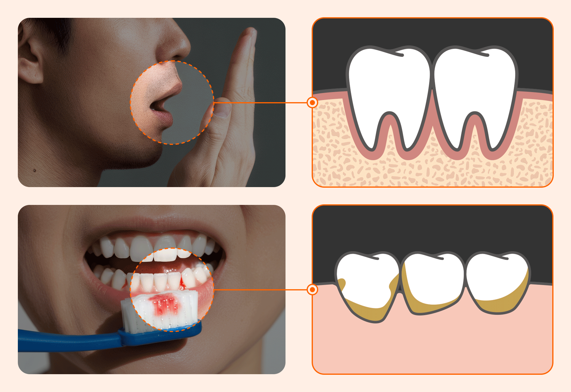 Comprehensive illustration showing both internal (alveolar bone loss, bacteria) and external (bleeding gums, bad breath) initial signs of periodontal disease