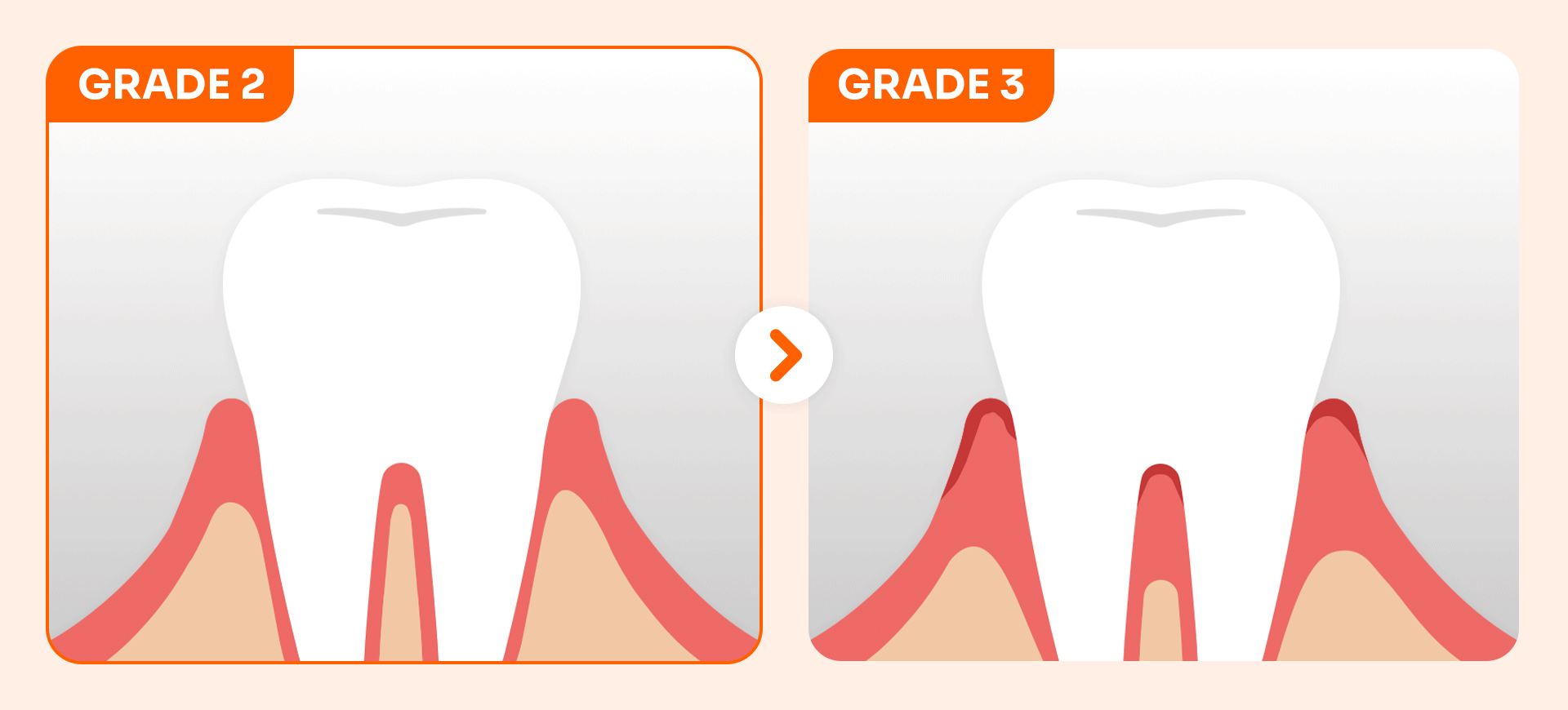 A visual representation based on the Miller mobility index (Grade II or higher), showing the dangerous state of a tooth shaking over 1mm due to more than half of the jawbone being lost