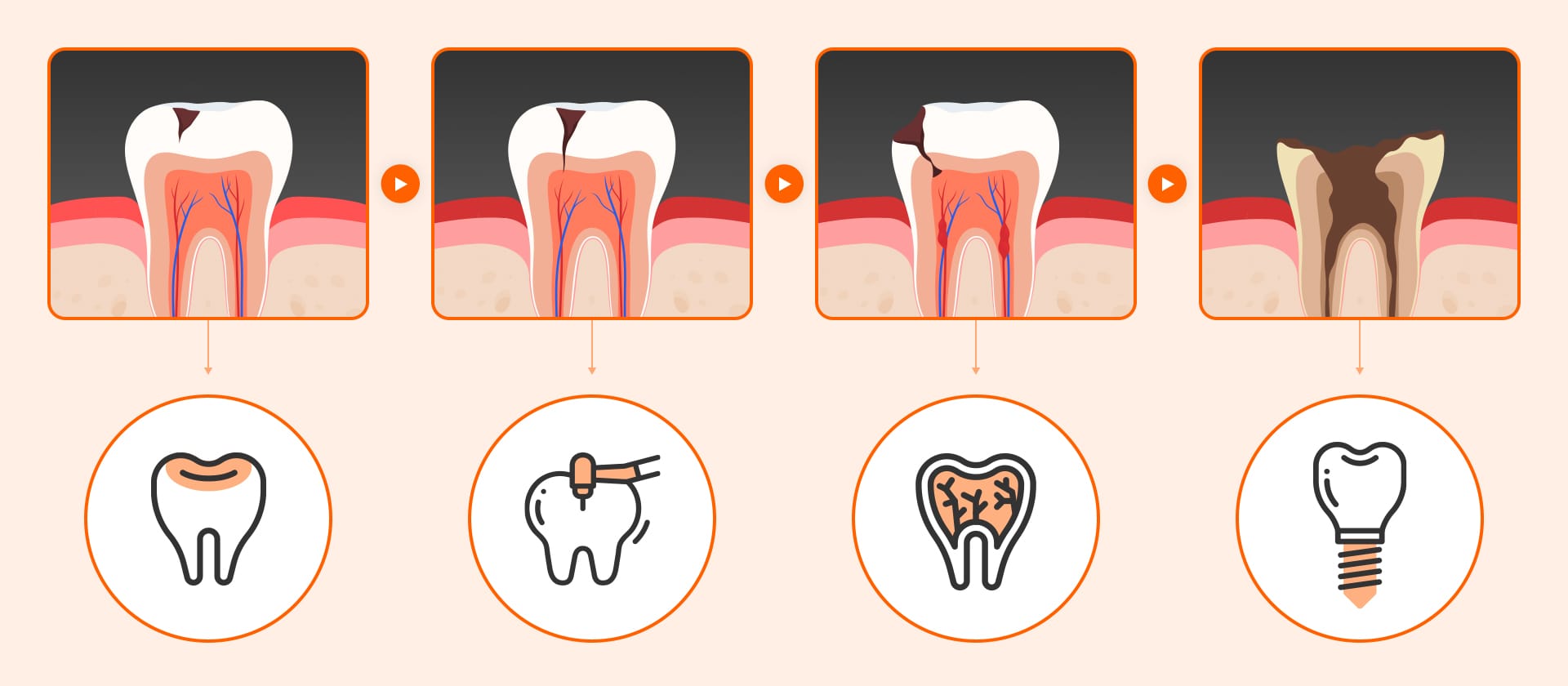 A timeline infographic showing appropriate corresponding treatments (resin, scaling, root canal, implant) based on the progression stage of decay/periodontal disease